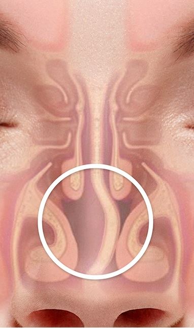 Deviated Septum Repair - Lake Jackson, TX