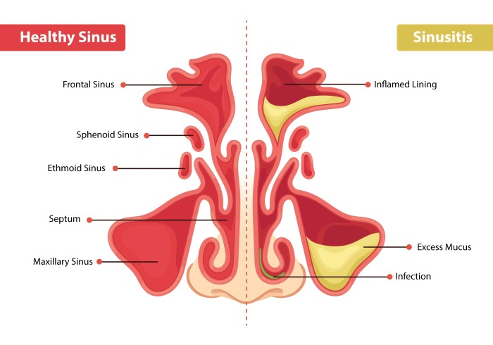 Sinusitis pain in Lake Jackson - Dr. Kimi Dart